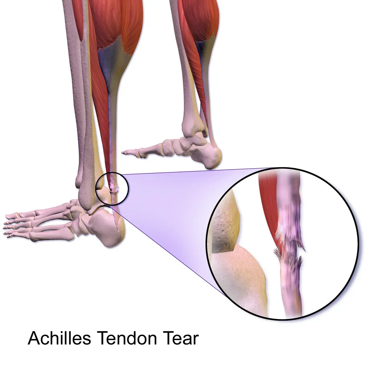 Medical illustration of a torn Achilles tendon with a magnified view of the frayed, separated tendon fibres