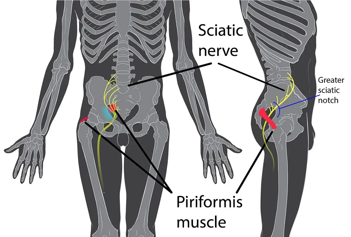 Diagram of the piriformis muscle in red at the back of the hip with the sciatic nerve in yellow running past it and down the leg