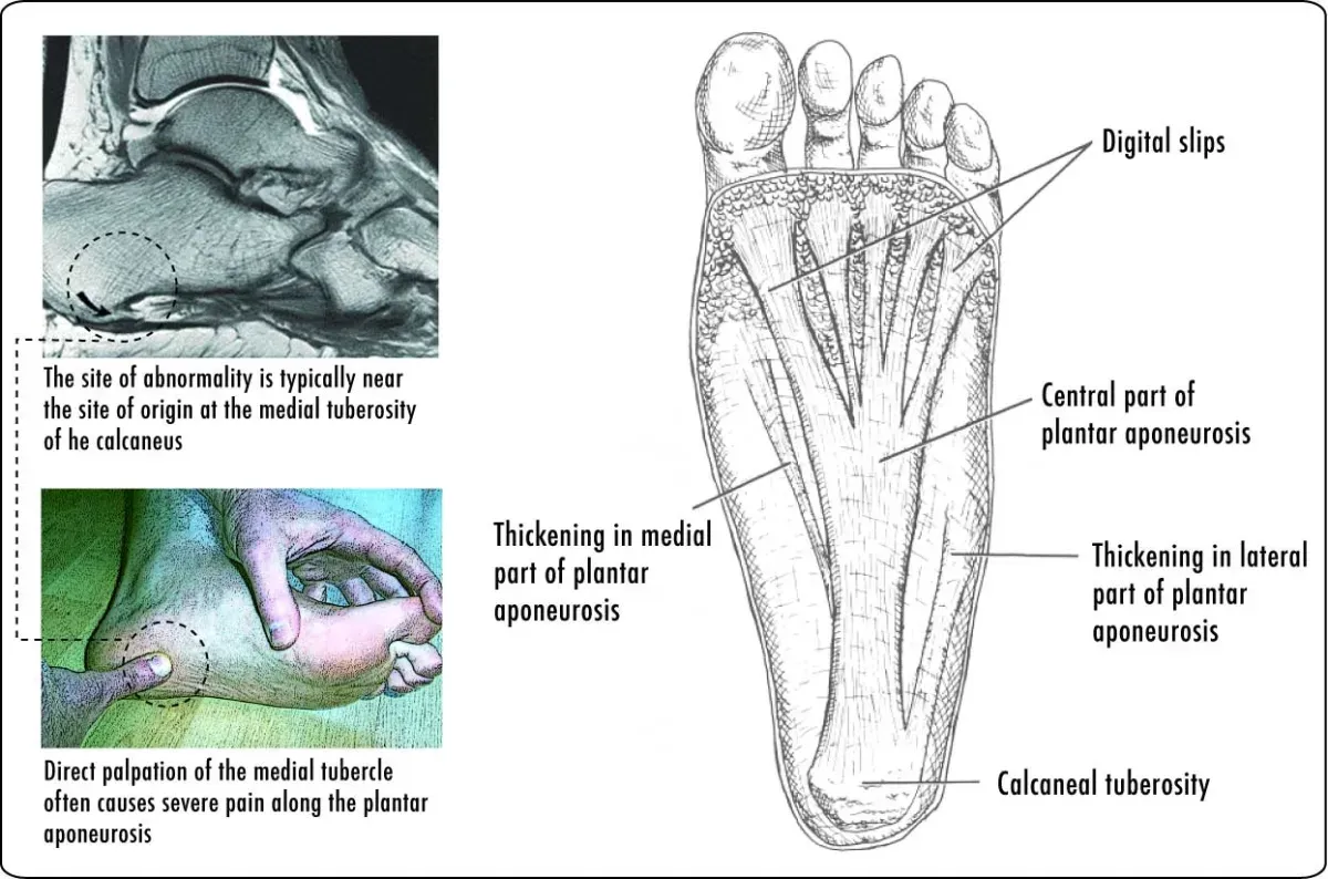 Labelled diagram of the sole showing the plantar aponeurosis running from the calcaneal tuberosity to the toes, beside an MRI and a photo of the tender spot being pressed